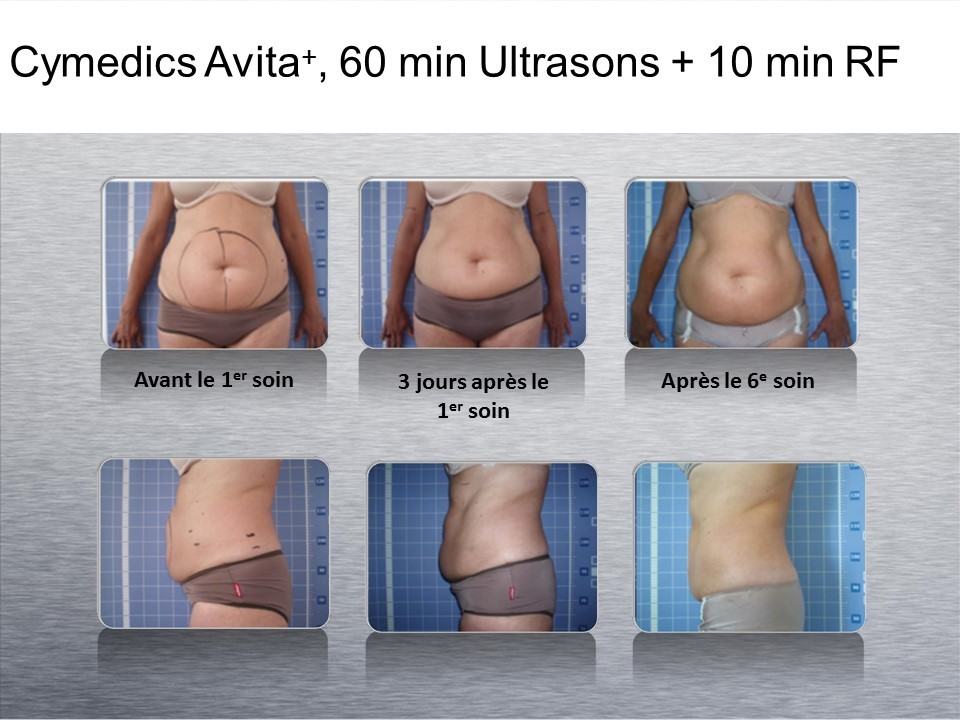 Avita+ Ultrasound